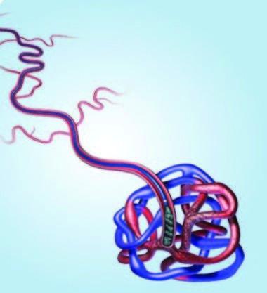 Líquido Embólico Onyx